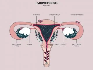 Endometriosi e social: verso una sempre maggiore sensibilizzazione